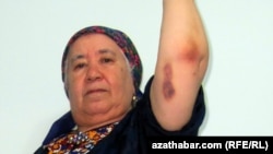 RFE/RL Turkmen Service correspondent Soltan Achilova displays some of the bruises she suffered during an attack in late October in Ashgabat.